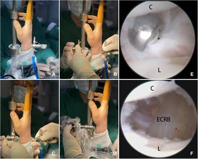 Treatment of dorsal wrist ganglion cyst by establishing midcarpal volar portal using the “Kiss-in” method